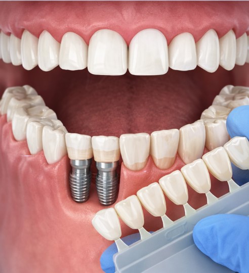 Full Mouth Reconstruction