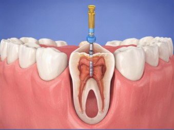 Root Canal